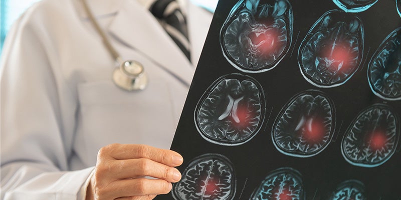 Brain accident