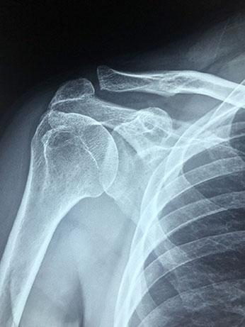 bone fracture injuries