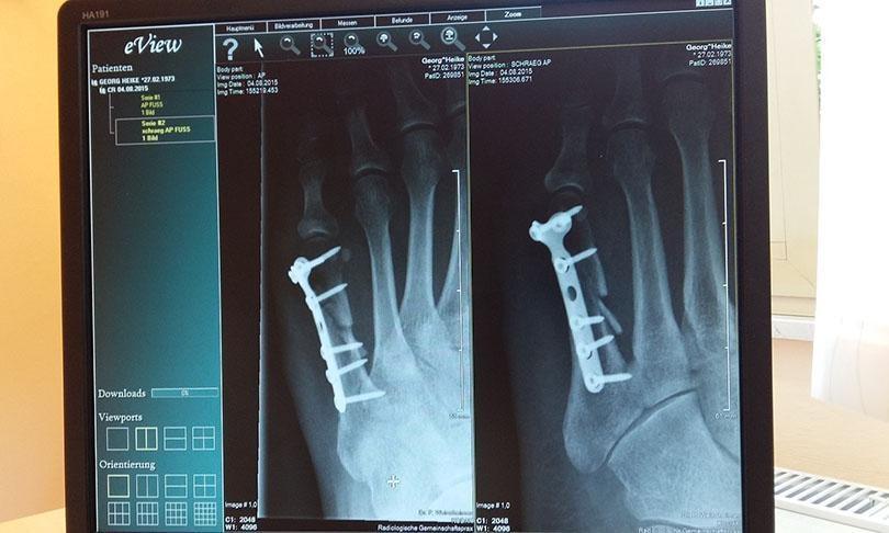 accidente peatonal fractura ósea